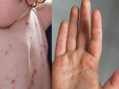 Tomato Fever: குழந்தைகளுக்கு பாதிப்பு! பீதி கிளப்பும் தக்காளி காய்ச்சல்! அறிகுறி என்ன? சிகிச்சை என்ன?