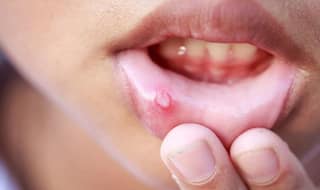 Home Remedies for Ulcers: ਮੂੰਹ ਦੇ ਛਾਲਿਆਂ ਤੋਂ ਹੋ ਪ੍ਰੇਸ਼ਾਨ ਤਾਂ ਅਪਣਾਓ ਇਹ ਘਰੇਲੂ ਨੁਸਖੇ
