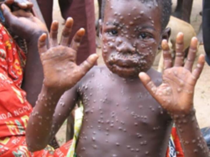 Monkeypox Virus: இங்கிலாந்தில் ஒருவருக்கு MonkeyPox தொற்று… மனித குலத்திற்கு புதிய ஆபத்தா? அதென்ன குரங்கு காய்ச்சல்?