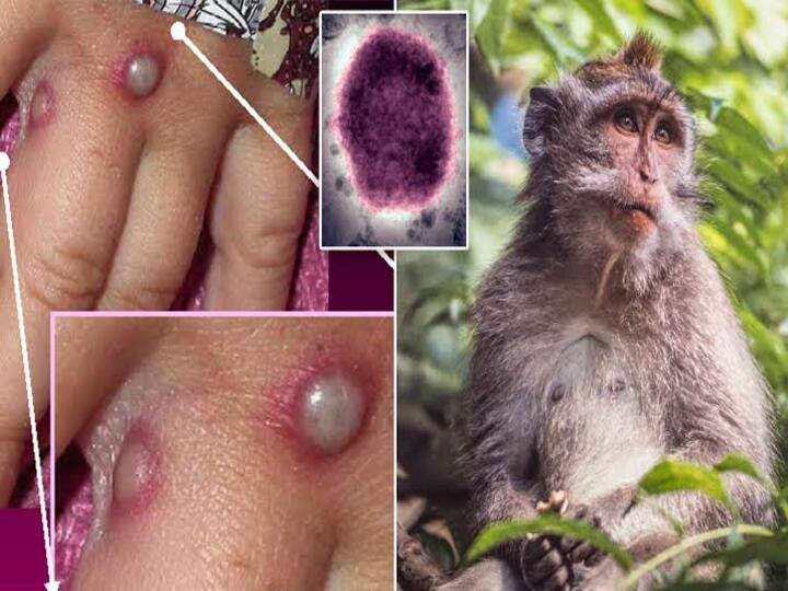 Monkeypox Virus Case Confirmed in UK What is Monkeypox Know All Details Monkeypox Virus: இங்கிலாந்தில் ஒருவருக்கு MonkeyPox தொற்று… மனித குலத்திற்கு புதிய ஆபத்தா? அதென்ன குரங்கு காய்ச்சல்?