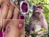 Monkeypox Virus: இங்கிலாந்தில் ஒருவருக்கு MonkeyPox தொற்று… மனித குலத்திற்கு புதிய ஆபத்தா? அதென்ன குரங்கு காய்ச்சல்?