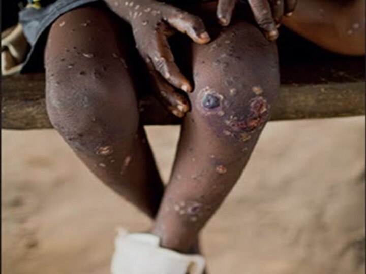 Monkeypox Virus: இங்கிலாந்தில் ஒருவருக்கு MonkeyPox தொற்று… மனித குலத்திற்கு புதிய ஆபத்தா? அதென்ன குரங்கு காய்ச்சல்?