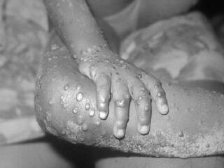 Monkeypox : कोरोनानंतर आता नव्या ‘मंकीपॉक्स’ विषाणूचा शिरकाव, काय आहेत ‘या’ विषाणूची लक्षणे? जाणून घ्या...