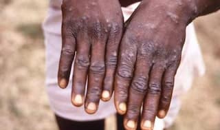 Monkeypox: अमेरिकेसह अनेक देशांमध्ये मंकीपॉक्सचा प्रसार, हा आजार किती धोकादायक, कसा बचाव कराल?