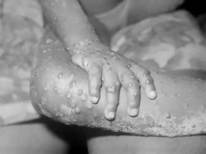 Monkeypox: How Can You Catch It And What Are The Symptoms Monkeypox: क्या है मंकीपॉक्स वायरस, जानिए संक्रमण के लक्षण और बचाव के उपाय