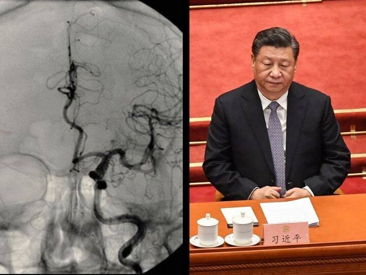 EXPLAINED What Is Cerebral Aneurysm The Cerebrovascular Disease Xi Jinping Is Said To Be Suffering From