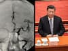 EXPLAINED | What Is Cerebral Aneurysm? The Cerebrovascular Disease Xi Jinping Is Said To Be Suffering From