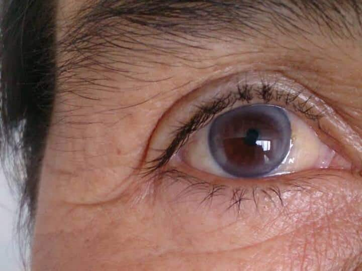 What your eyes reveal about your health diseases that identify by eye changes உடல்நல பிரச்னைகளை 'கண்' காட்டிக்கொடுக்கும்! கண்கள் சொல்லும் மருத்துவ எச்சரிக்கைகள்!