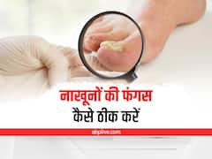 Health Tips: नाखूनों में भी लग जाती है फंगस, जानिए ठीक करने के लिए क्या करें?