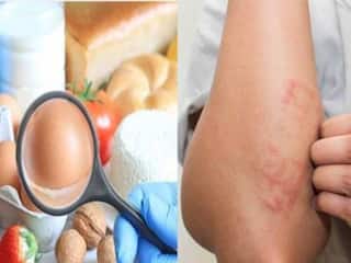 Food Allergy: फूड अ‍ॅलर्जी आणि फूड इंटॉलरन्स यात काय आहे फरक? जाणून घ्या
