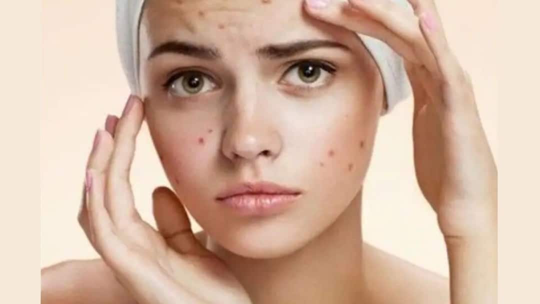 Simple Ways to Fight Pimples and Acne in Summers, know in details Summer Care: গরমে ব্রনর সমস্যা সমাধানে ঘরোয়া টোটকা