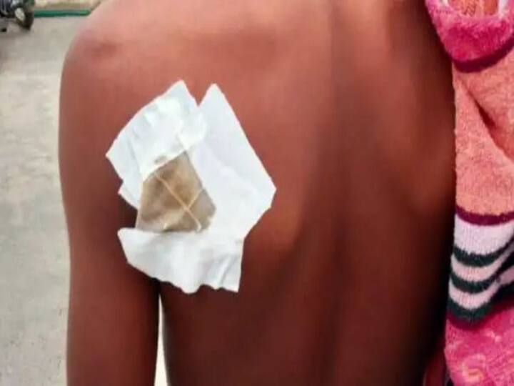 காவேரிப்பட்டினம் : ’மாம்பழம் சாப்பிடுவதில் தகராறு’ : அரசு பள்ளியில் 10-ஆம் வகுப்பு மாணவனை கத்தியால் குத்திய மாணவர்