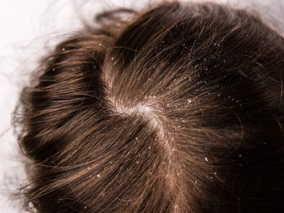 Hair Dandruff : डैंड्रफ से हैं परेशान? इन घरेलू उपायों से स्कैल्प संक्रमण को कुछ ही दिनों में करें दूर Hair Dandruff : डैंड्रफ से हैं परेशान? इन घरेलू उपायों से स्कैल्प संक्रमण को कुछ ही दिनों में करें दूर