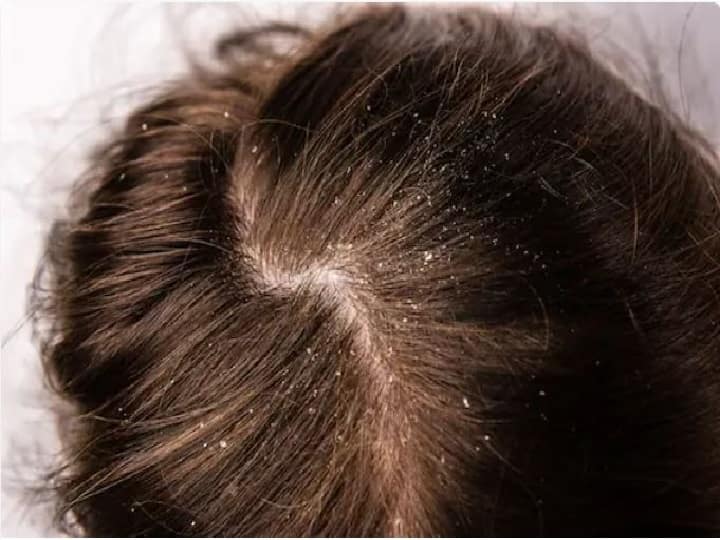 Dandruff Hair Care Dandruff Treatment Fungal Infection Scaly Scalp Itchy  Scalp | Dandruff Cure: क्यों होती है डैंड्रफ की समस्या, क्या है इसका  पर्मानेंट इलाज