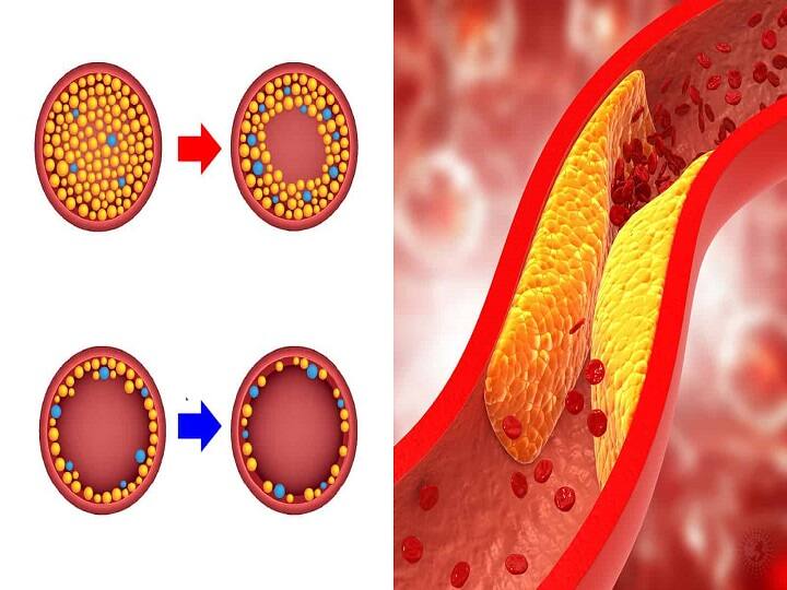 What is High Cholesterol It And Some Warning Signs High Cholesterol: உடலில் அதிக அளவு கொழுப்பு எவ்வளவு ஆபத்து? அபாய அறிகுறிகள் என்னென்ன?