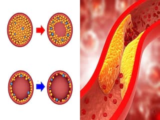 High Cholesterol : कोलेस्ट्रॉल वाढल्यावर पायांमध्ये दिसतील ही लक्षणं, दुर्लक्ष करु नका