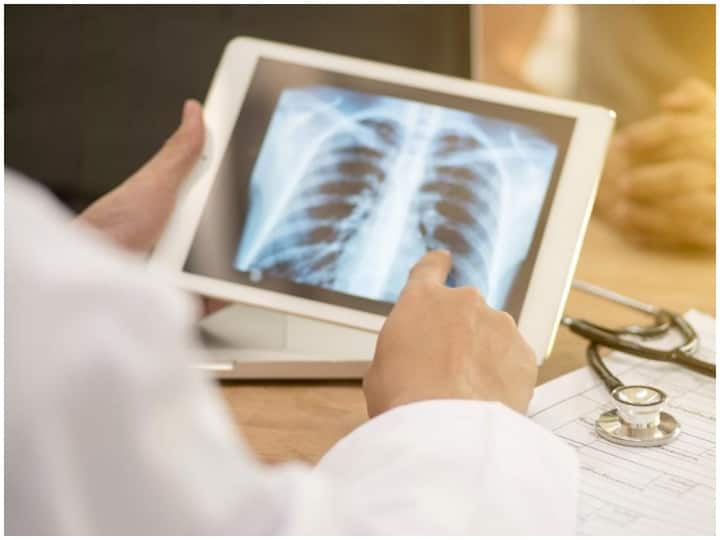 TB Patients: न जांच और न एक्सरे, अब ऐसे पता चल जाएगी टीबी की बीमारी TB Test now without xray and other tests doctors do experiment on new technology TB Patients: न जांच और न एक्सरे, अब ऐसे पता चल जाएगी टीबी की बीमारी