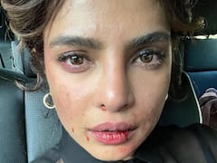 Priyanka Chopra Shares A Snapshot Of Her Injured Face From The set Of ‘Citadel’