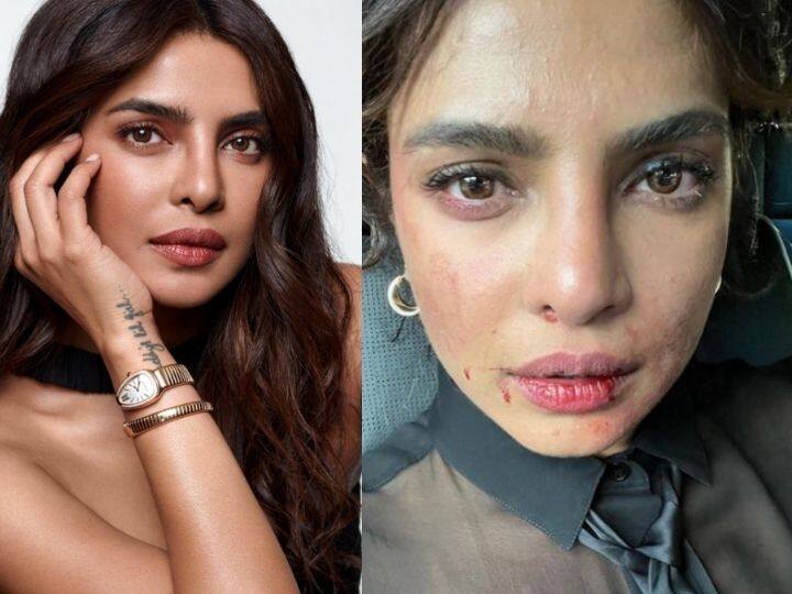 priyanka chopra injured during shooting of upcoming web series  Citadel Priyanka Chopra : प्रियांका चोप्राचा फोटो पाहून नेटकरी झाले थक्क; म्हणाले, 'चेहऱ्याला नक्की काय झालं आहे?'