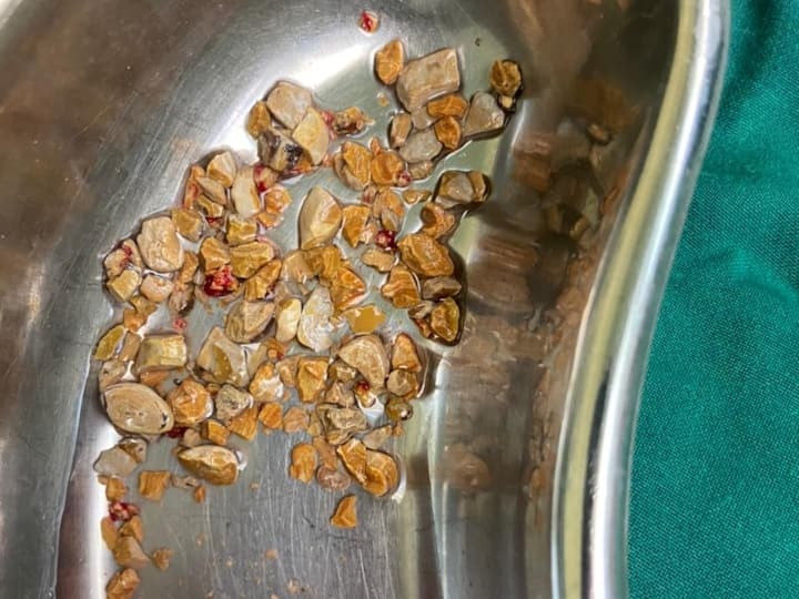 doctors removed 206 Stones From kidney of a man in Hyderabad Kidney Stones: मरीज की किडनी से निकाले 206 स्टोन, 6 महीनों से हो रहा था दर्द
