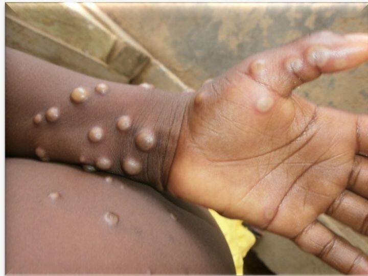Monkeypox Virus Case Confirmed in UK Know What is Monkeypox All you need to know EXPLAINED | First Case Of Monkeypox Confirmed In US. All About The Rare Viral Infection