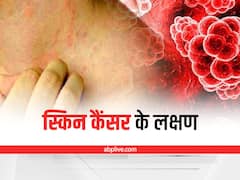 Skin Cancer: स्किन कैंसर के ये हैं शुरुआती लक्षण, शरीर के इन अंगों की हर महीने करें जांच
