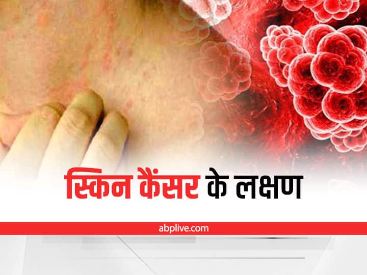 Skin Cancer: symptoms of skin cancer in hindi and how to check skin cancer spots Skin Cancer: स्किन कैंसर के ये हैं शुरुआती लक्षण, शरीर के इन अंगों की हर महीने करें जांच