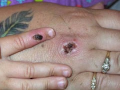 Monkeypox Virus Advisory: મંકીપોક્સના ફફડાટ વચ્ચે મોદી સરકારે રાજ્યોને કર્યા એલર્ટ, મહારાષ્ટ્ર સરકારે જાહેર કરી એડવાઇઝરી