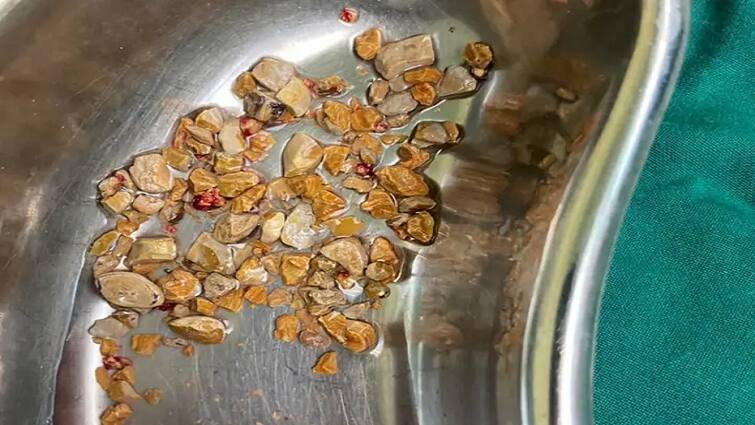 a doctor removed 206 stones from a patient's kidney In Hyderabad Kidney Stones: દર્દીની કિડનીમાંથી ડોક્ટરે કાઢી 206 પથરી, 6 મહિનાથી પેટમાં દુખાવો હતો
