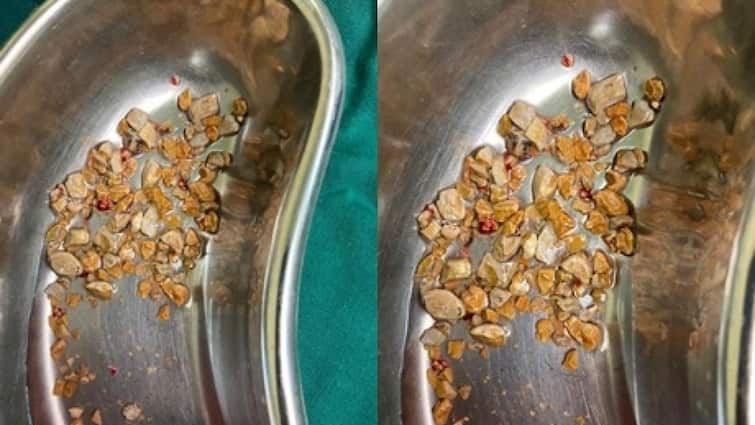Telangana : Doctors remove 206 kidney stones from 56-year-old man, this one mistake caused this ਮਰੀਜ਼ ਦੀ ਕਿਡਨੀ 'ਚੋਂ ਨਿਕਲੀਆਂ 206 ਪੱਥਰੀਆਂ , ਇਸ ਇਕ ਗਲਤੀ ਨਾਲ ਹੋਇਆ ਮਰੀਜ਼ ਦਾ ਬੁਰਾ ਹਾਲ