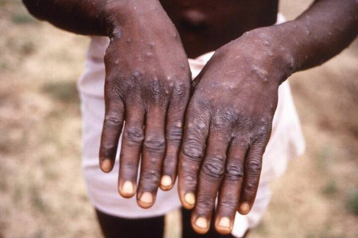 Africa contained monkeypox outbreaks during COVID marathi news Monkeypox Outbreaks : आफ्रिकेत 'मंकीपॉक्स'चा उद्रेक! कोरोना दरम्यान उद्भवलेल्या नवीन रोगामुळे शास्त्रज्ञांसमोर आव्हान