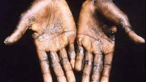 Monkeypox Outbreak 200 confirmed cases of Monkeypox across 20 countries WHO briefing Monkeypox Confirmed Cases: দ্রুত ছড়াচ্ছে মাঙ্কিপক্স, ২০টি দেশ জুড়ে ২০০টি সংক্রমণ!