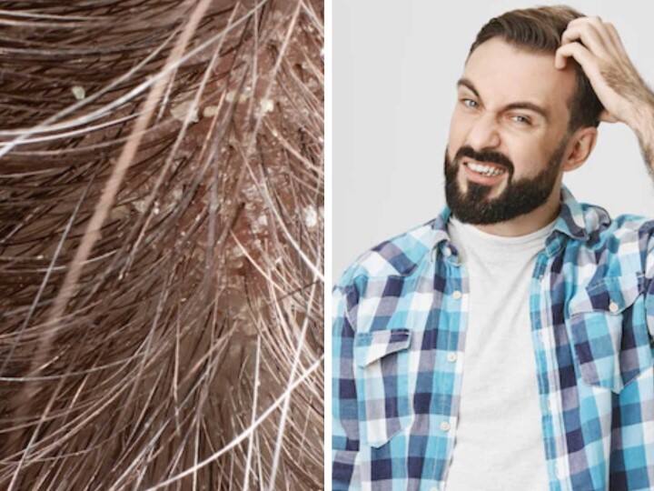 Major Causes Of Dandruff And How To Treat Them Dandruff Treatment