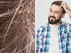 Dandruff Treatment: చుండ్రు ఏర్పడటానికి కారణాలివే, రోజూ ఇలా చేస్తే మళ్లీ రమ్మన్నారాదు!