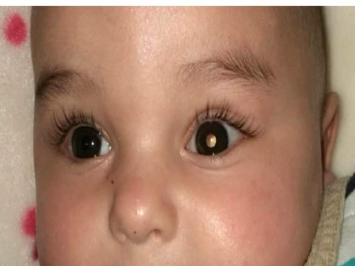 Know about Retinoblastoma: A rare cancer that affects eyes; mostly children குழந்தைகளை அச்சுறுத்தும் புற்றுநோய்! ரெட்டினோ பிளாஸ்டோமா தெரியுமா? விவரம் இதுதான்!!