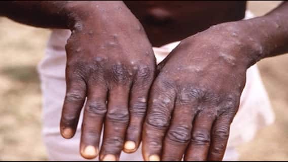 Monkey Pox: দেশে উদ্বেগ বাড়াচ্ছে মাঙ্কি পক্স, কী এই রোগের প্রাথমিক লক্ষণ? Bangla News