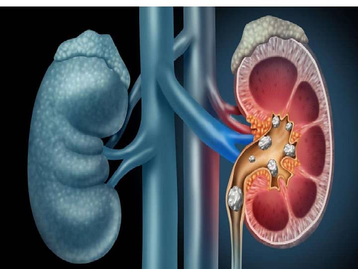 Do summer heat, dehydration increase risk of kidney stone formation? Kidney Stone Formation : கோடை வெயிலால் இப்படி ஒரு பிரச்சனையா? சிறுநீரகத்துக்கு இப்படி ஒரு ஆபத்தா?