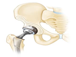 Hip Bone Symptoms : राज ठाकरेंवर हिप बोनची शस्त्रक्रिया; हा आजार नेमका काय? वाचा संपूर्ण माहिती