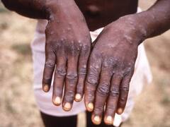 92 Confirmed Cases Of Monkeypox Till Now, No Established Travel Links To Endemic Areas, Says WHO – Top Points