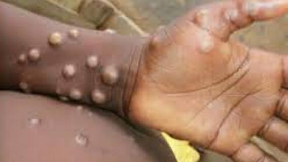 Monkeypox: ইউরোপে মাঙ্কি-পক্সের প্রকোপ, রাজ্যগুলিকে সতর্ক করল কেন্দ্র। Bangla News