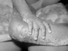 MonkeyPox In Israel: યૂરોપ બાદ હવે ઈઝરાયલમાં પહોંચ્યો મંકીપૉક્સ