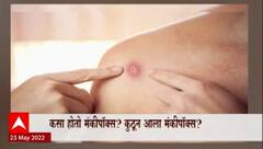 Monkeypox : कसा होतो मंकीपॉक्स? कुठून आला मंकीपॉक्स? Special Report