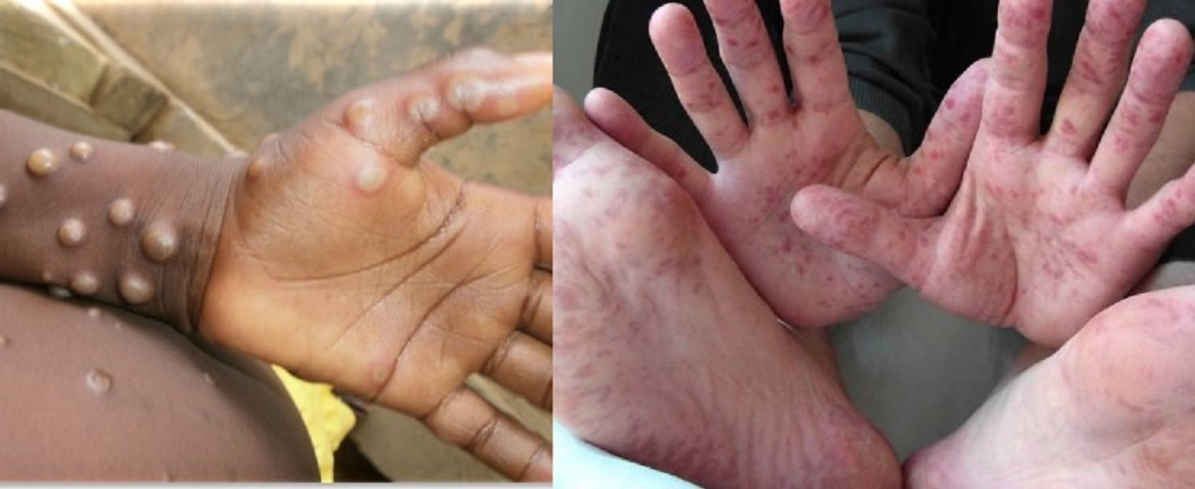 India Has Not Registered Any Case Of Monkeypox But Tracked Closely Officials Said Yesterday | Monkeypox In India: भारत में मंकीपॉक्स का एक भी केस नहीं, जानिए दो वेरिएंट वाले वायरस से