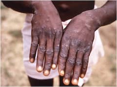 MP News: मंकीपॉक्स को लेकर सतर्क हुई मध्य प्रदेश सरकार, हवाई अड्डों पर विदेश से आने वालों की हो रही है निगरानी