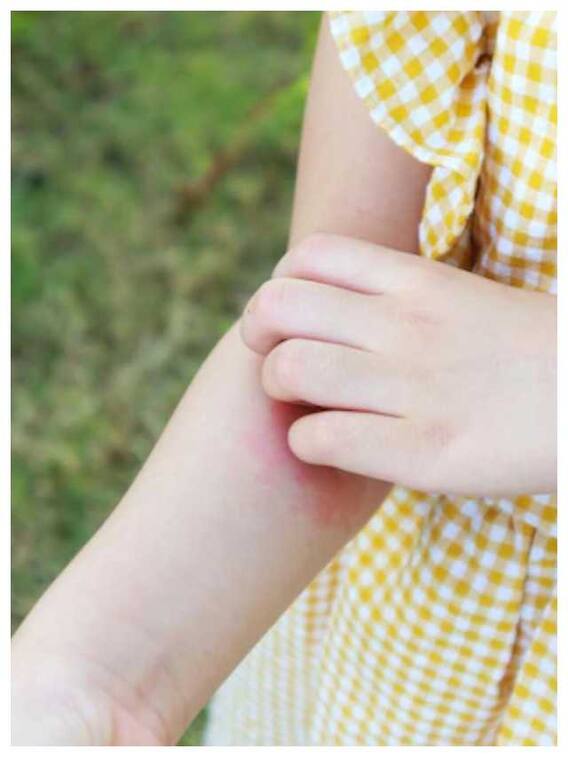 गर्मी में स्किन रैशेज की समस्या दूर करने के उपाय