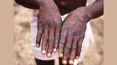 Monkey Pox: ইউরোপ থেকে আসা যাত্রীদের শরীরে র‍্যাশ থাকলে সতর্কতা, নির্দেশ কেন্দ্রের। Bangla News