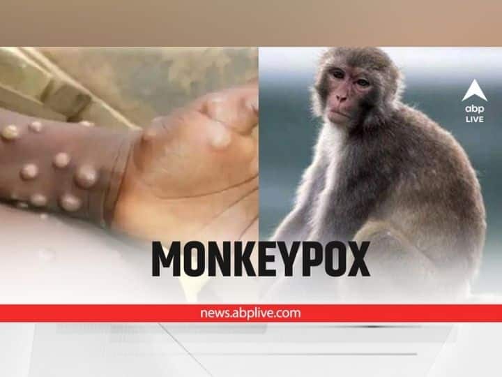 EXPLAINED How Can Monkeypox Be Treated List Of Vaccines And Therapeutics Available EXPLAINED | Is There A Treatment For Monkeypox? See List Of Therapeutics And Vaccines Available