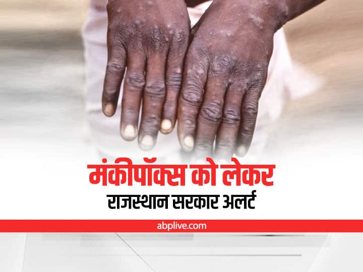 Rajasthan government advisory regarding monkeypox said Isolation will be done when patient is found Rajasthan News: कई देशों में मंकीपॉक्स के मामले मिलने के बाद राजस्थान सरकार अलर्ट, जारी की ये एडवाइजरी