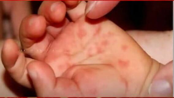 Tomato Flu: মাঙ্কি ফ্লু-র পর এবার টম্যাটো ফ্লু, দক্ষিণ ভারতে আক্রান্ত শতাধিক শিশু।Bangla News