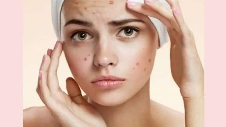 Have oily, acne-prone skin? Avoid these four mistakes, know in details Pimple: যে ভুলগুলোর কারণে ব্রণর সমস্যা বৃদ্ধি পায়
